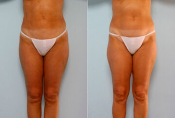 Liposuction before and after photos in Houston, TX, Patient 28887