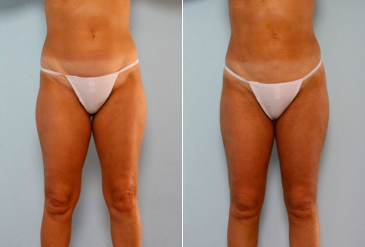 Liposuction before and after photos in Houston, TX, Patient 28887