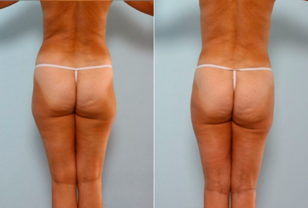 Liposuction before and after photos in Houston, TX, Patient 28887