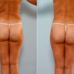 Liposuction before and after photos in Houston, TX, Patient 28887
