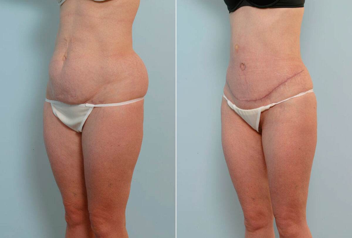 Abdominoplasty before and after photos in Houston, TX, Patient 24655