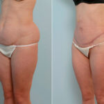 Abdominoplasty before and after photos in Houston, TX, Patient 24655