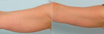 Liposuction before and after photos in Houston, TX, Patient 28906