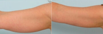 Liposuction before and after photos in Houston, TX, Patient 28906