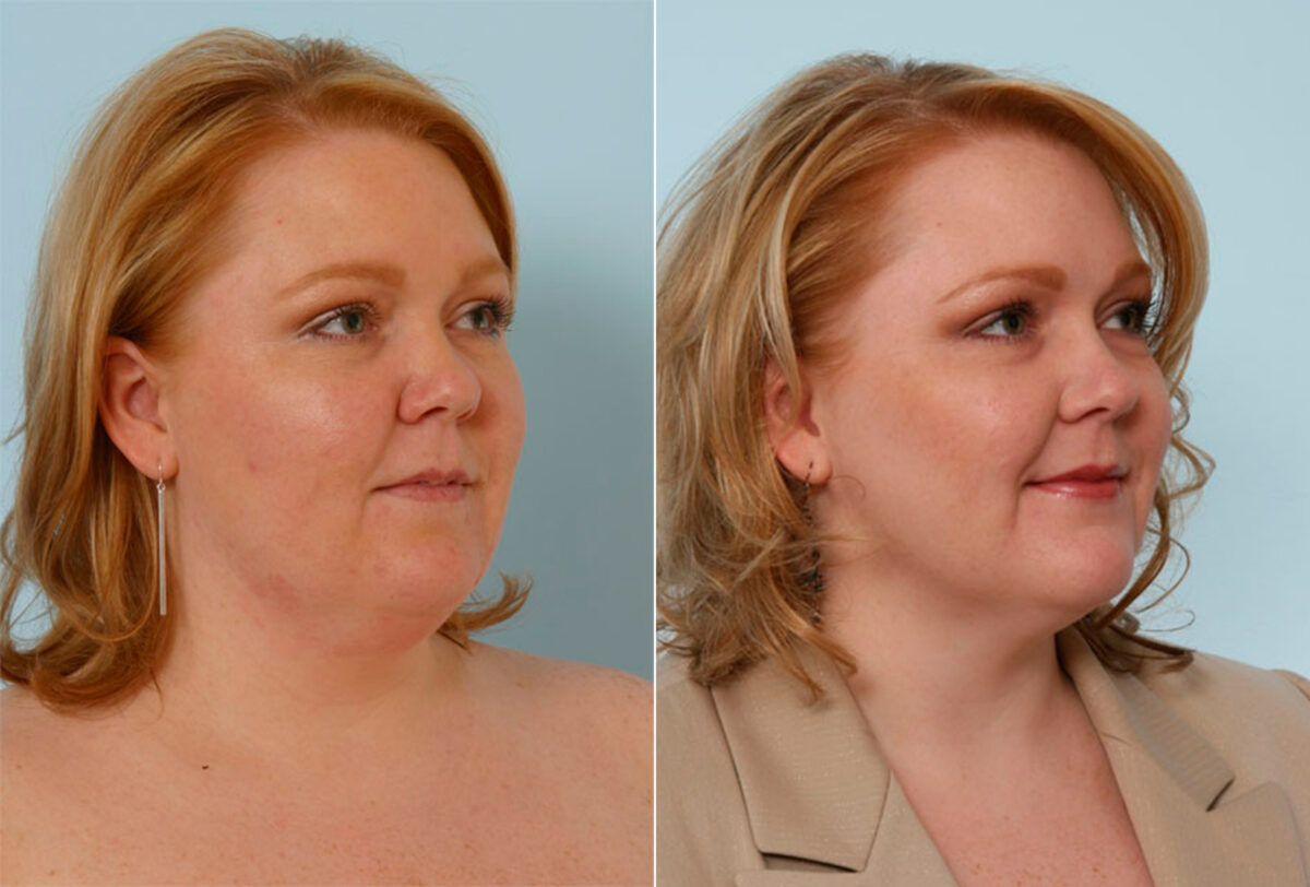 Liposuction before and after photos in Houston, TX, Patient 28909