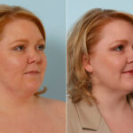 Liposuction before and after photos in Houston, TX, Patient 28909