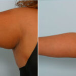 Liposuction before and after photos in Houston, TX, Patient 28914