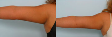 Liposuction before and after photos in Houston, TX, Patient 28914