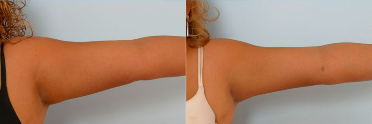 Liposuction before and after photos in Houston, TX, Patient 28914