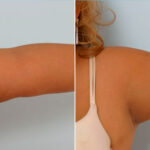 Liposuction before and after photos in Houston, TX, Patient 28914