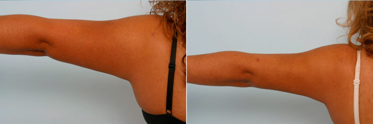 Liposuction before and after photos in Houston, TX, Patient 28914