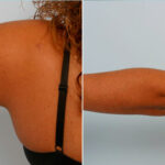 Liposuction before and after photos in Houston, TX, Patient 28914