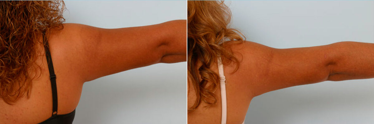 Liposuction before and after photos in Houston, TX, Patient 28914