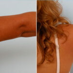 Liposuction before and after photos in Houston, TX, Patient 28914