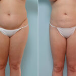 Liposuction before and after photos in Houston, TX, Patient 28921