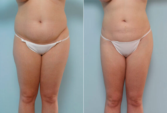 Liposuction before and after photos in Houston, TX, Patient 28921