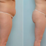 Liposuction before and after photos in Houston, TX, Patient 28921