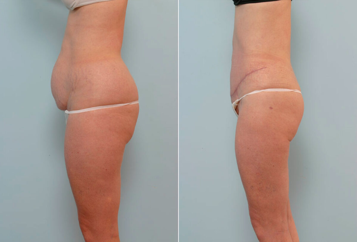 Abdominoplasty before and after photos in Houston, TX, Patient 24655