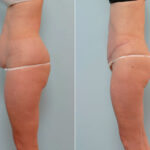 Abdominoplasty before and after photos in Houston, TX, Patient 24655