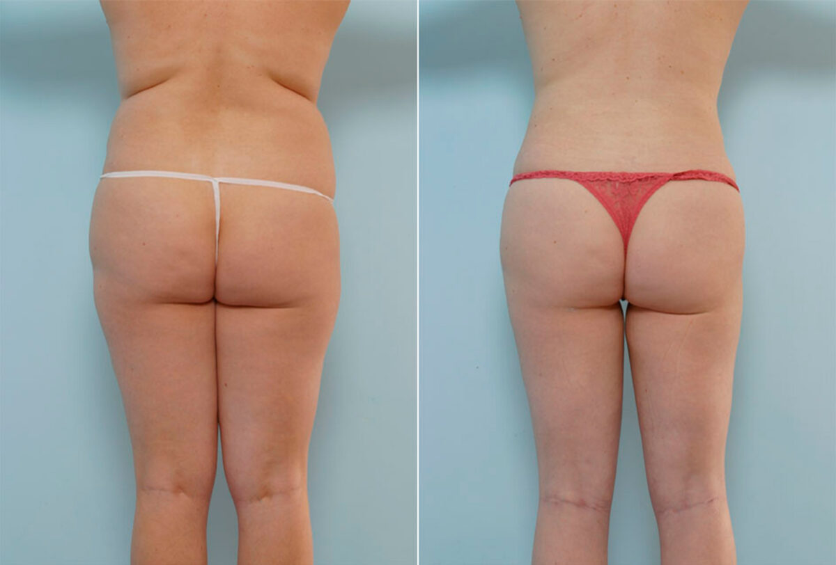 Liposuction before and after photos in Houston, TX, Patient 28921