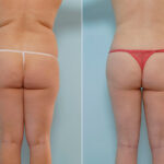 Liposuction before and after photos in Houston, TX, Patient 28921