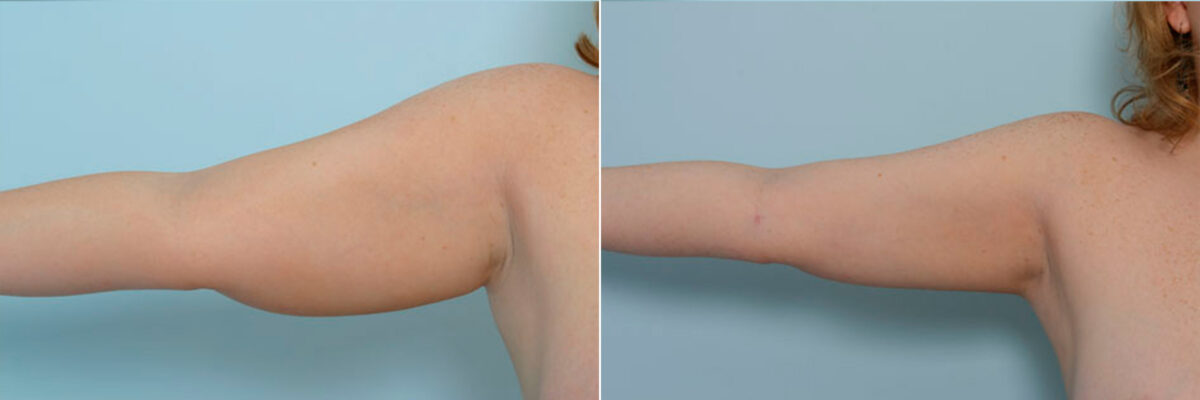 Liposuction before and after photos in Houston, TX, Patient 28921