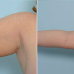 Liposuction before and after photos in Houston, TX, Patient 28921