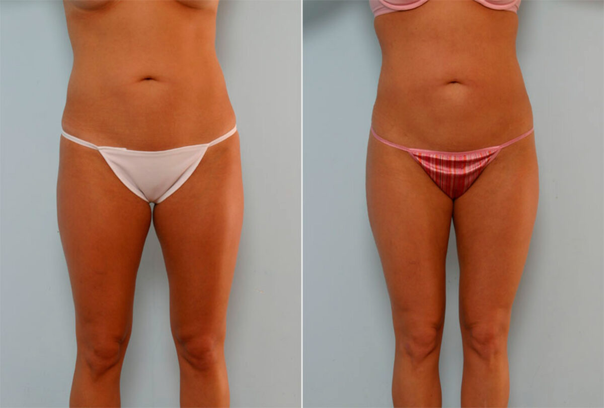 Liposuction before and after photos in Houston, TX, Patient 28936