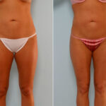 Liposuction before and after photos in Houston, TX, Patient 28936