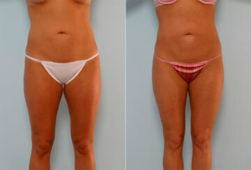 Liposuction before and after photos in Houston, TX, Patient 28936