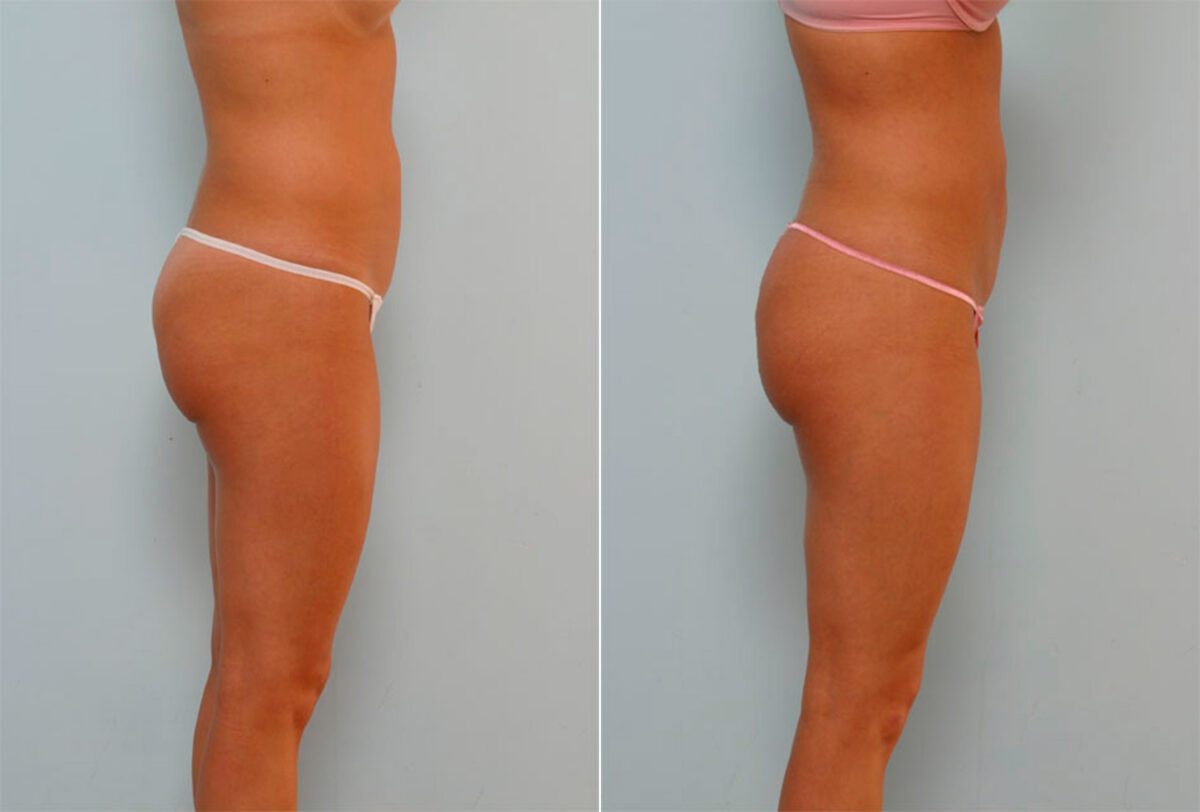 Liposuction before and after photos in Houston, TX, Patient 28936