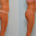 Liposuction before and after photos in Houston, TX, Patient 28936