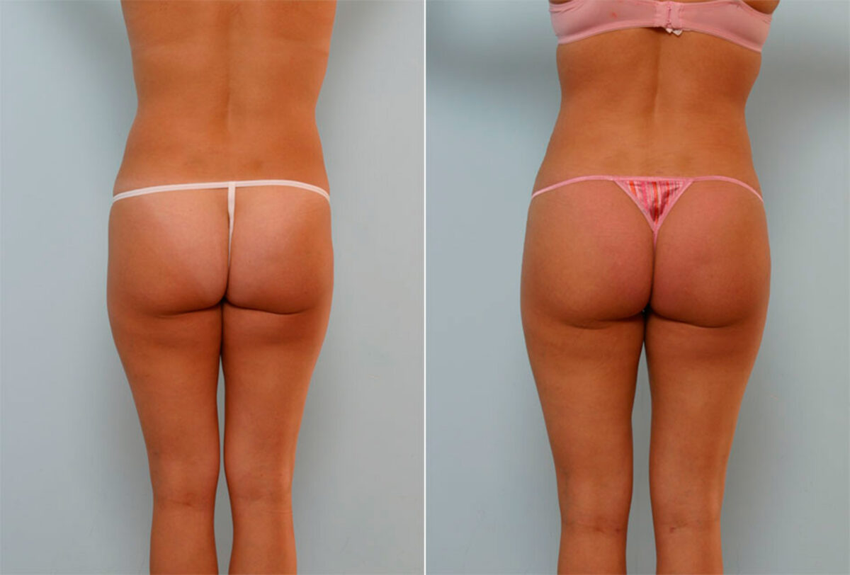 Liposuction before and after photos in Houston, TX, Patient 28936