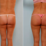 Liposuction before and after photos in Houston, TX, Patient 28936