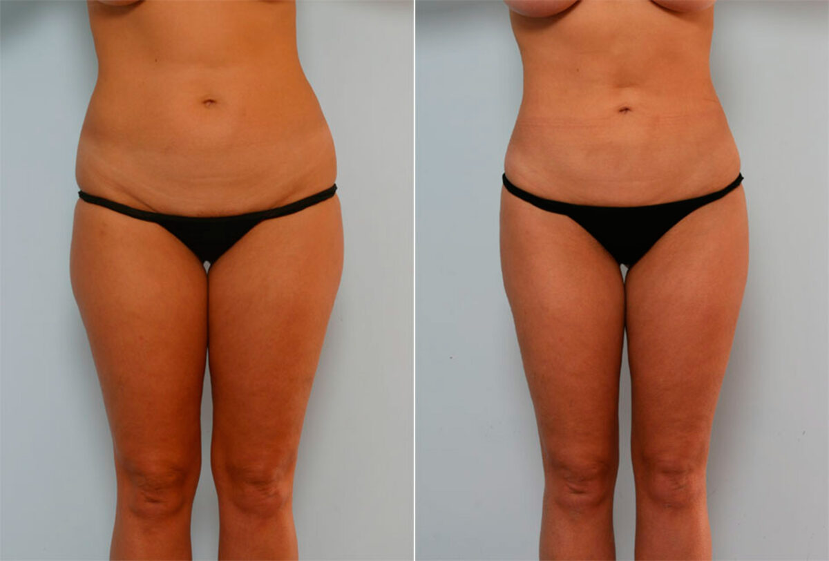 Liposuction before and after photos in Houston, TX, Patient 28943