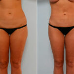 Liposuction before and after photos in Houston, TX, Patient 28943