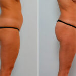 Liposuction before and after photos in Houston, TX, Patient 28943