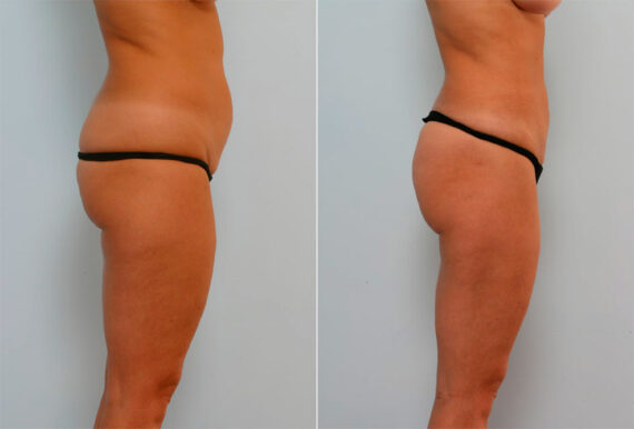 Liposuction before and after photos in Houston, TX, Patient 28943