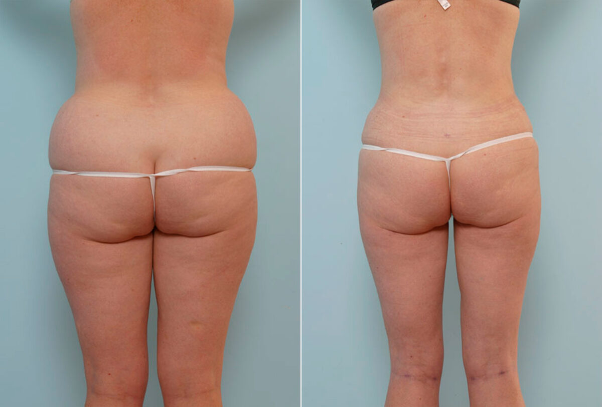 Abdominoplasty before and after photos in Houston, TX, Patient 24655