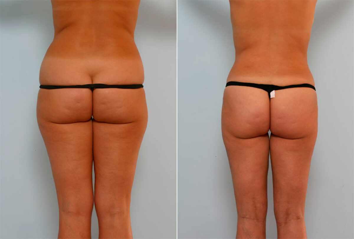 Liposuction before and after photos in Houston, TX, Patient 28943