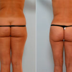 Liposuction before and after photos in Houston, TX, Patient 28943