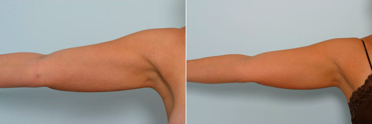 Liposuction before and after photos in Houston, TX, Patient 28943