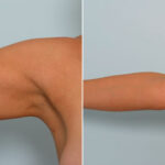 Liposuction before and after photos in Houston, TX, Patient 28943