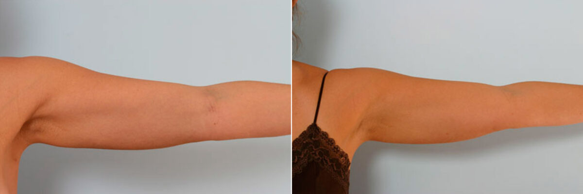 Liposuction before and after photos in Houston, TX, Patient 28943