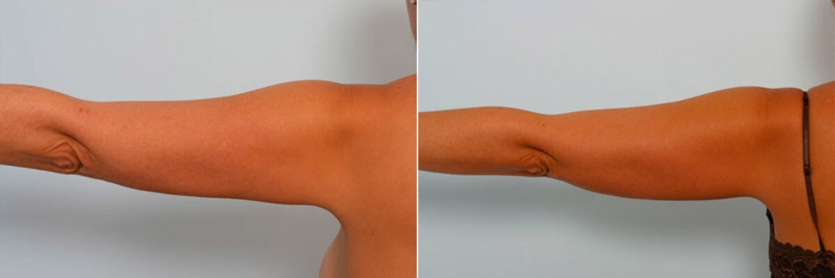 Liposuction before and after photos in Houston, TX, Patient 28943