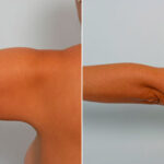 Liposuction before and after photos in Houston, TX, Patient 28943