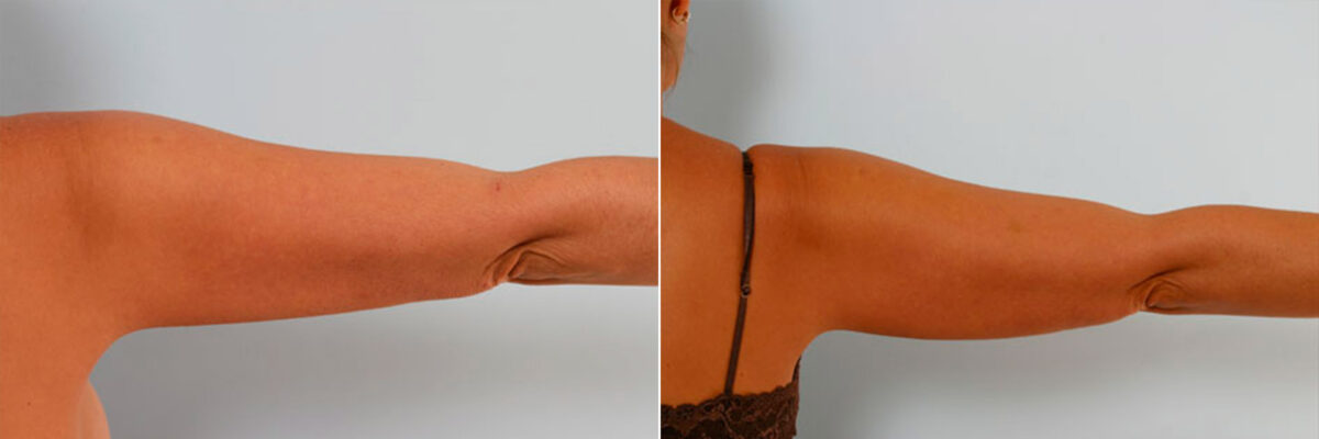 Liposuction before and after photos in Houston, TX, Patient 28943