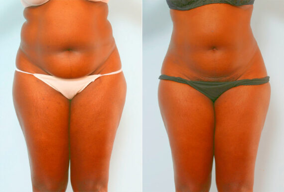 Liposuction before and after photos in Houston, TX, Patient 28958