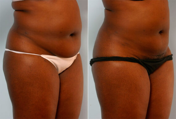 Liposuction before and after photos in Houston, TX, Patient 28958