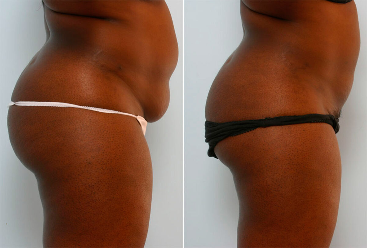 Liposuction before and after photos in Houston, TX, Patient 28958